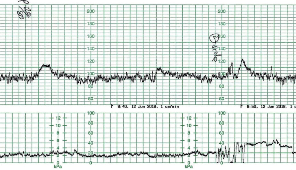 reactive fetal heart rate tracing