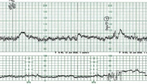 The Fetal Bradycardia – O&G Magazine