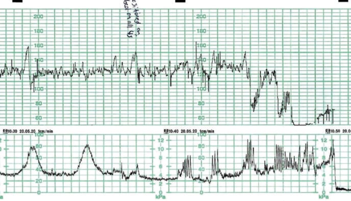 The Fetal Bradycardia – O&G Magazine