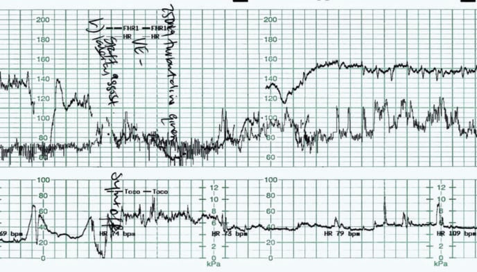 The Fetal Bradycardia – O&G Magazine