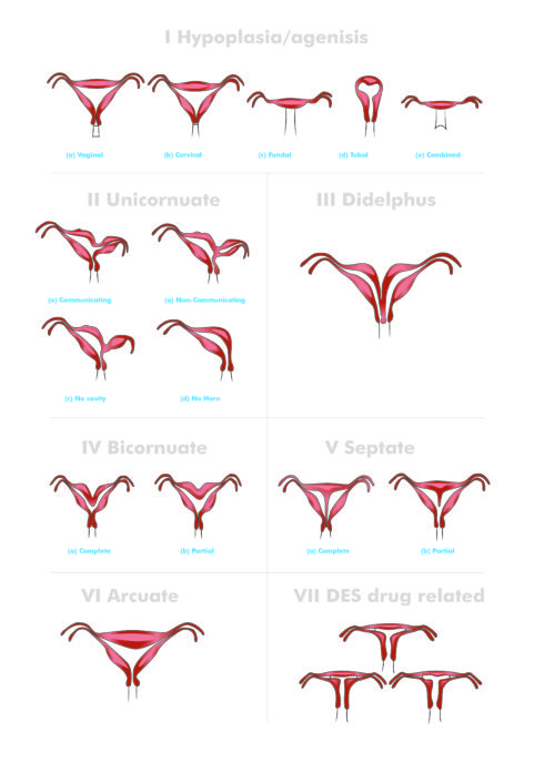 Congenital anomalies of the female genital tract – O&G Magazine