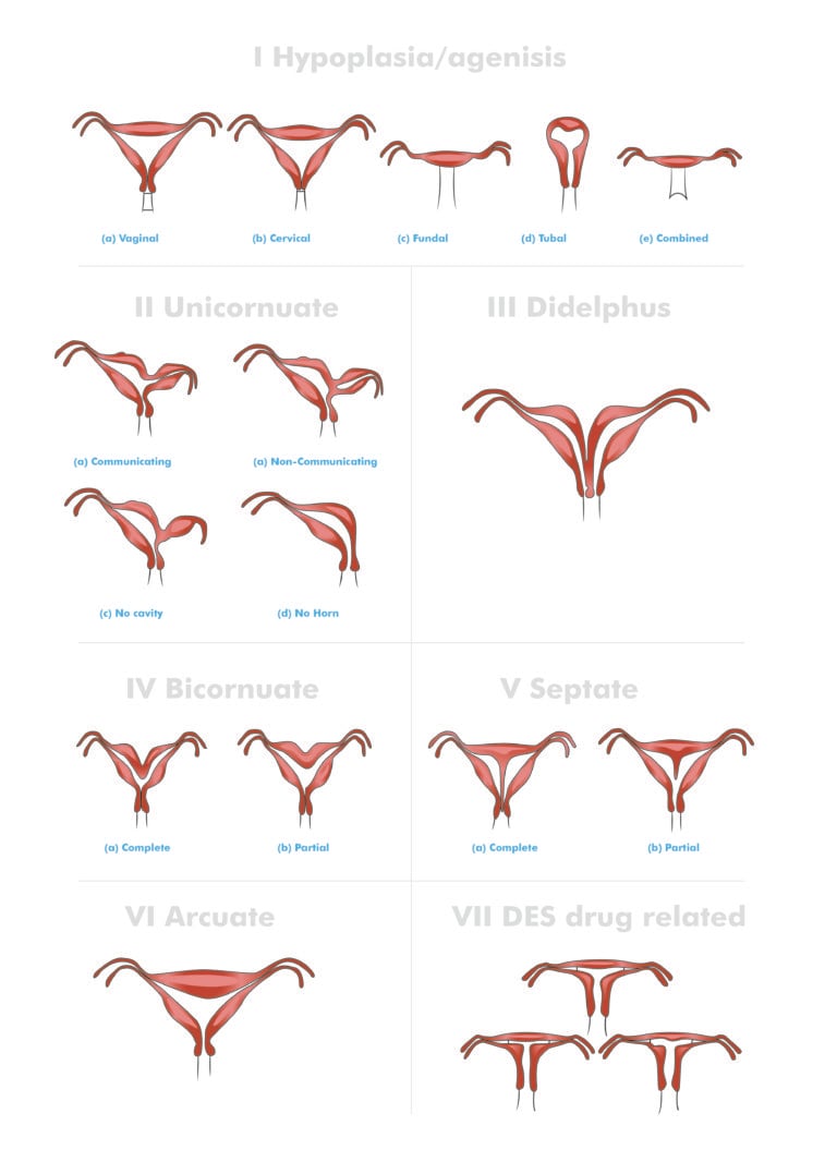 Congenital Anomalies Of The Female Genital Tract O G Magazine