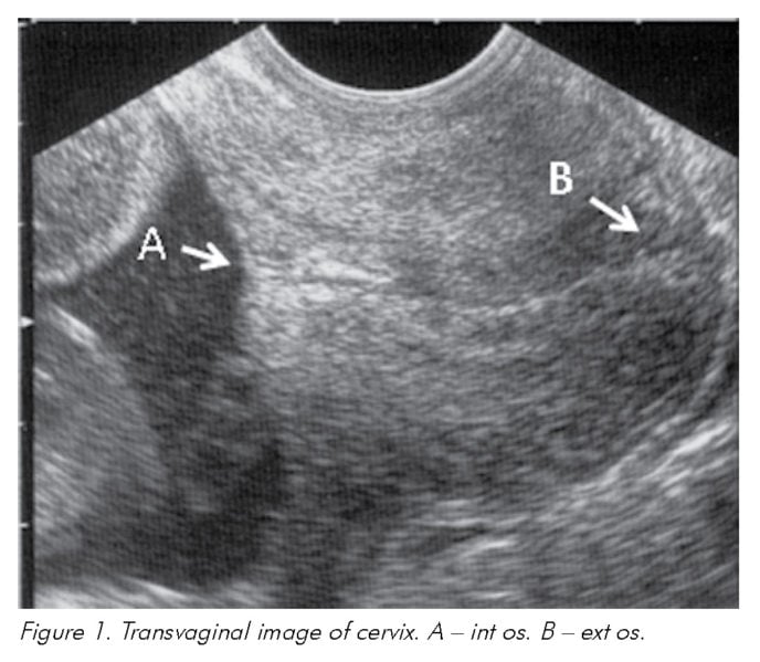 What Is A Good Cervical Length At 20 Weeks