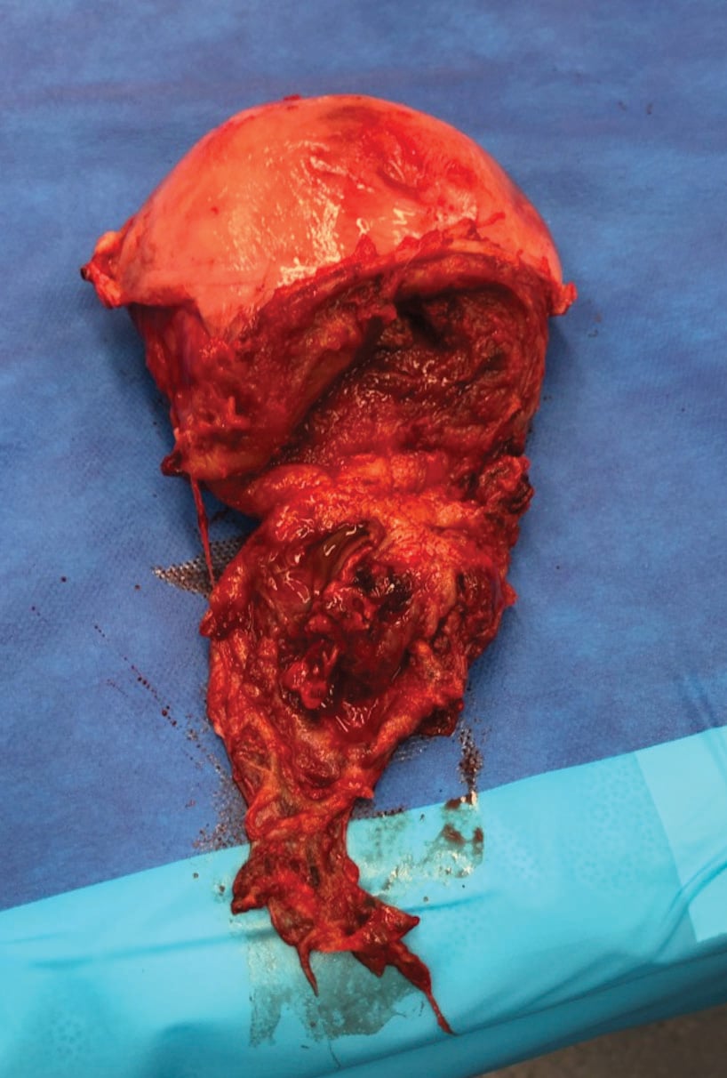 Uterine rupture secondary to placenta percreta – O&G Magazine