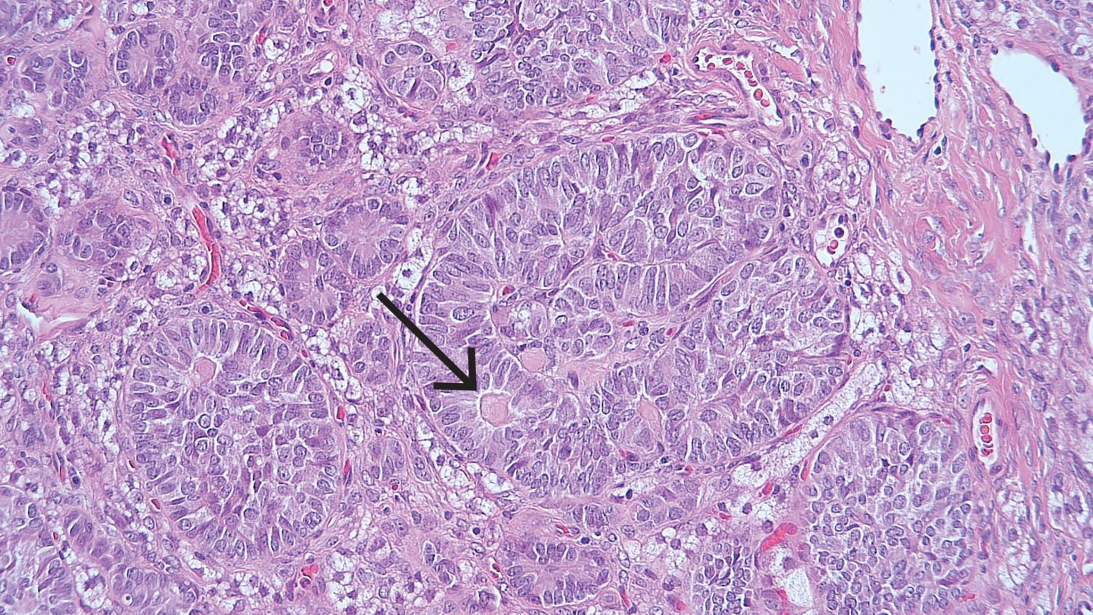 Tumour Pathology And Classification Oandg Magazine